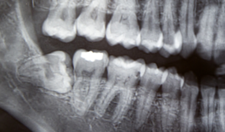 横向きの歯のレントゲン写真