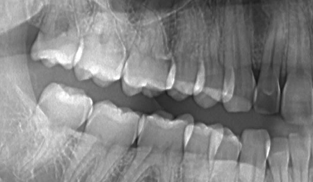 まっすぐな歯のレントゲン写真